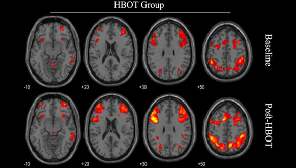 Functional MRI before and after HBOT  Photo credit: The Shamir Medical Center.