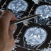 Discovery could help treat Alzheimer's