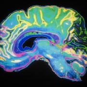 New TAU Research Links Alzheimer's Disease to Brain Hyperactivity