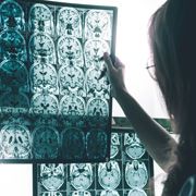 TAU Team Reverses Early Signs of Alzheimer's 